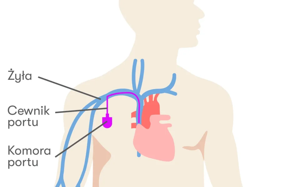 porty naczyniowe przy chemioterapii