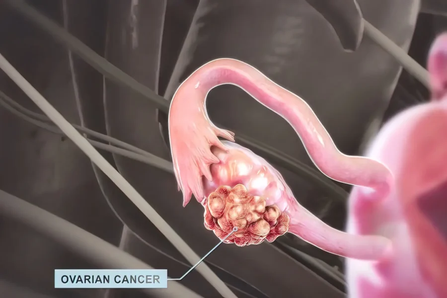 Przełom w różnicowaniu guzów jajnika