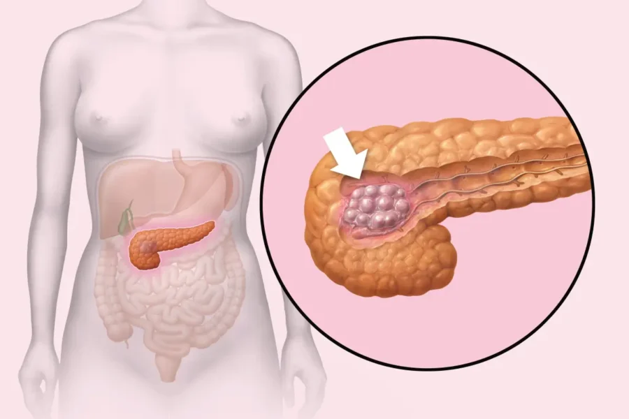 diagnostyka nowotworu złośliwego trzustki
