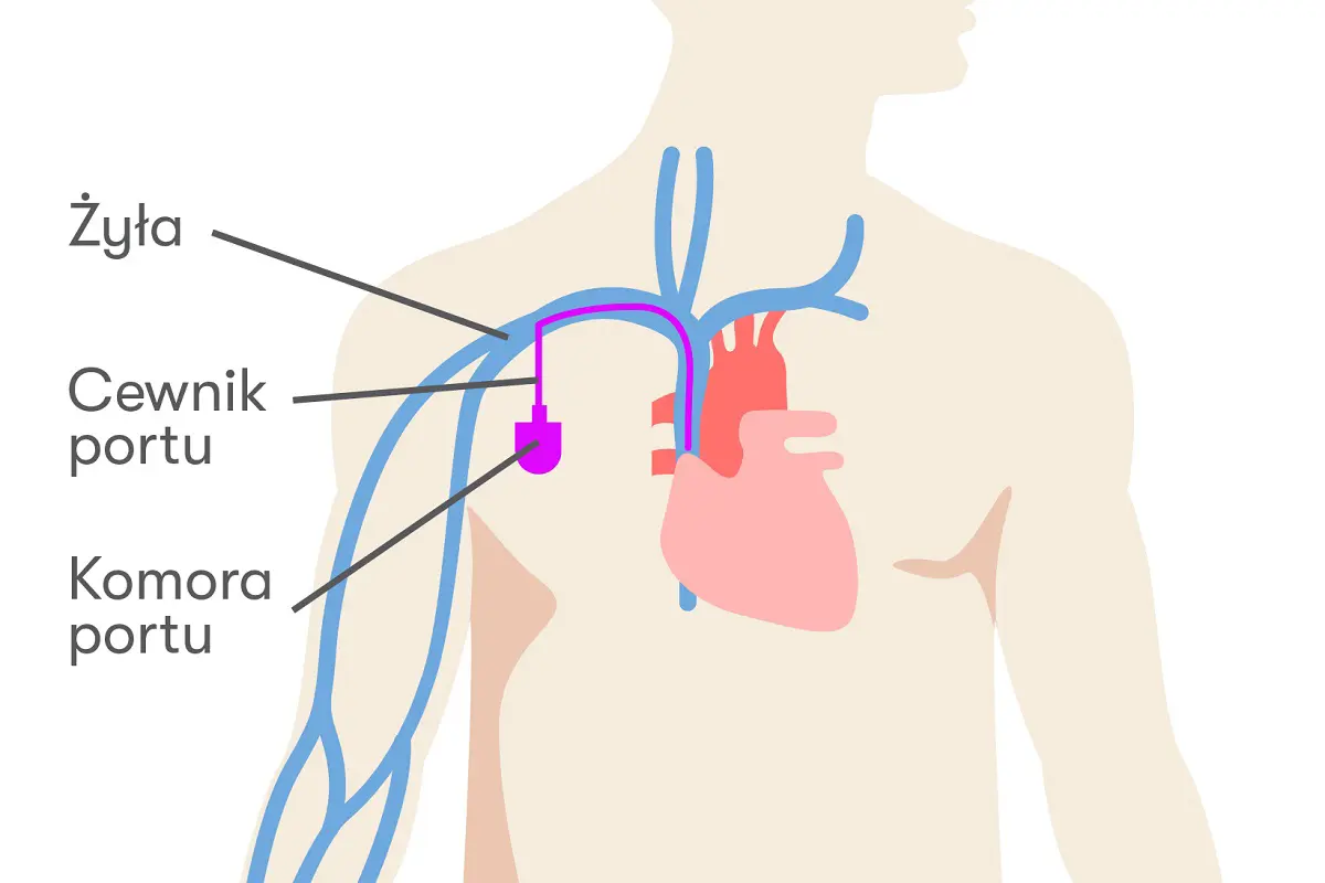 Rozpoczynasz chemioterapię? Zgłoś się do nas! Implantujemy porty naczyniowe w ramach NFZ