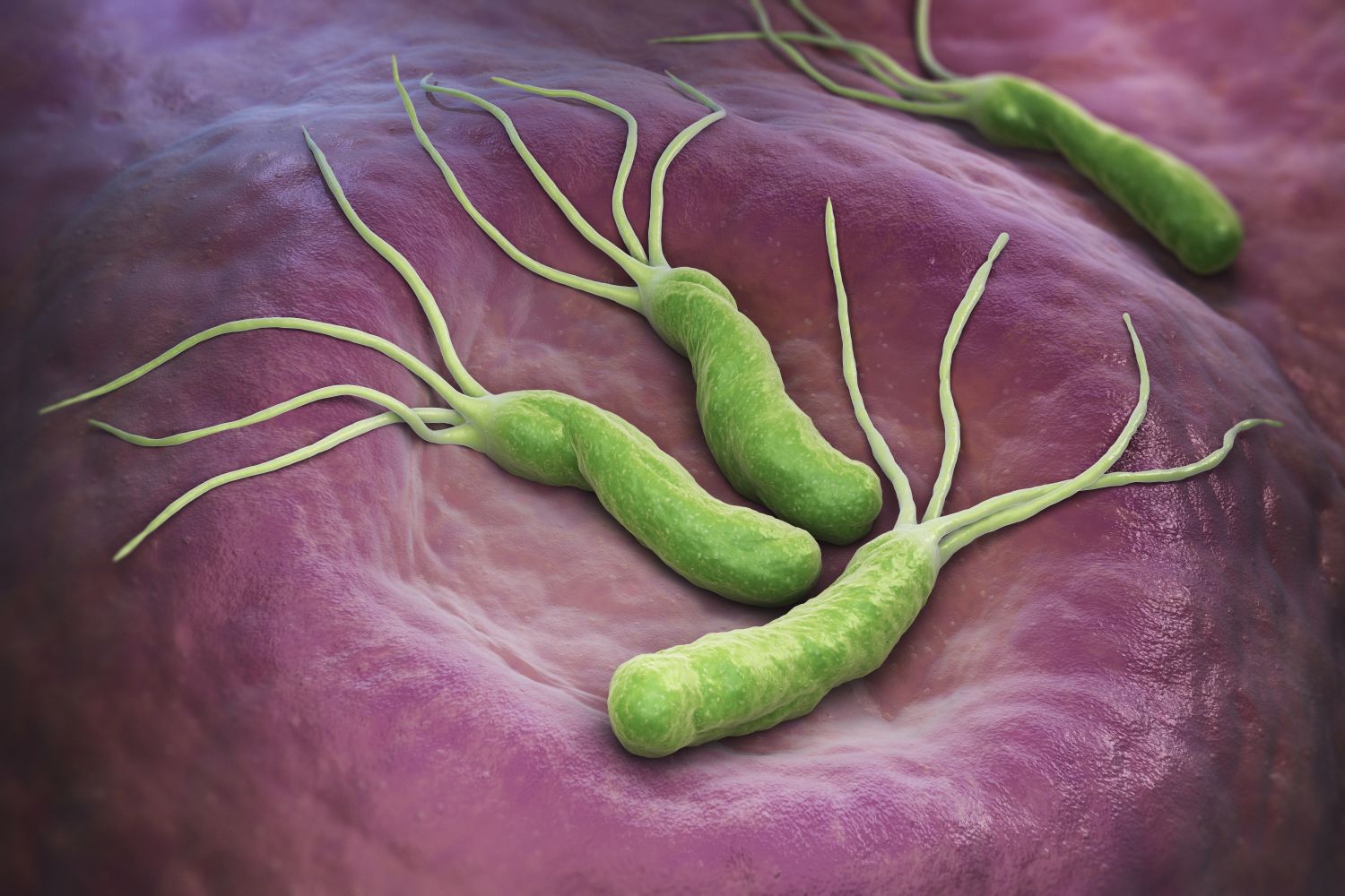 Helicobacter pylori zwiększa ryzyko rozwoju nowotworu żołądka